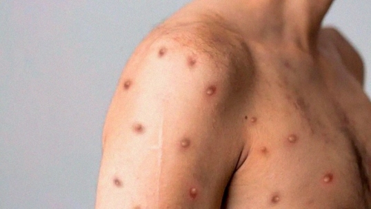 Confirman el primer caso autóctono de viruela símica en el país