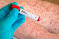Aumentan los casos de sífilis en Argentina